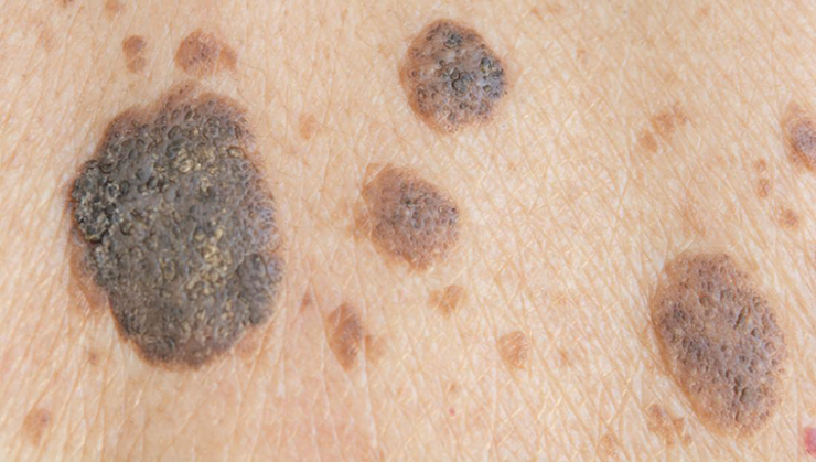 Seborrheic keratosis | LP-CLINIC