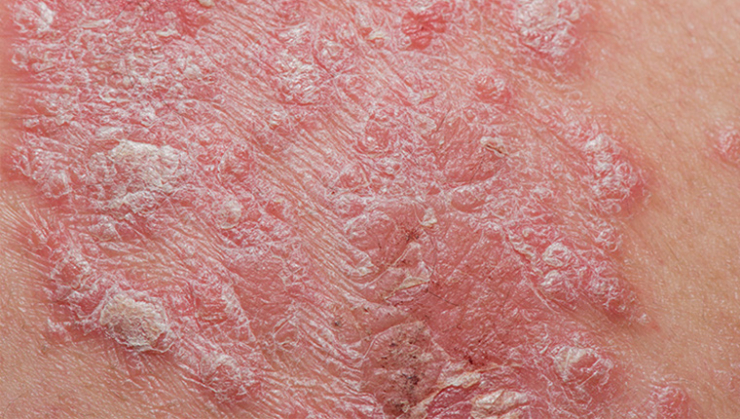 Psoriasis | LP-CLINIC