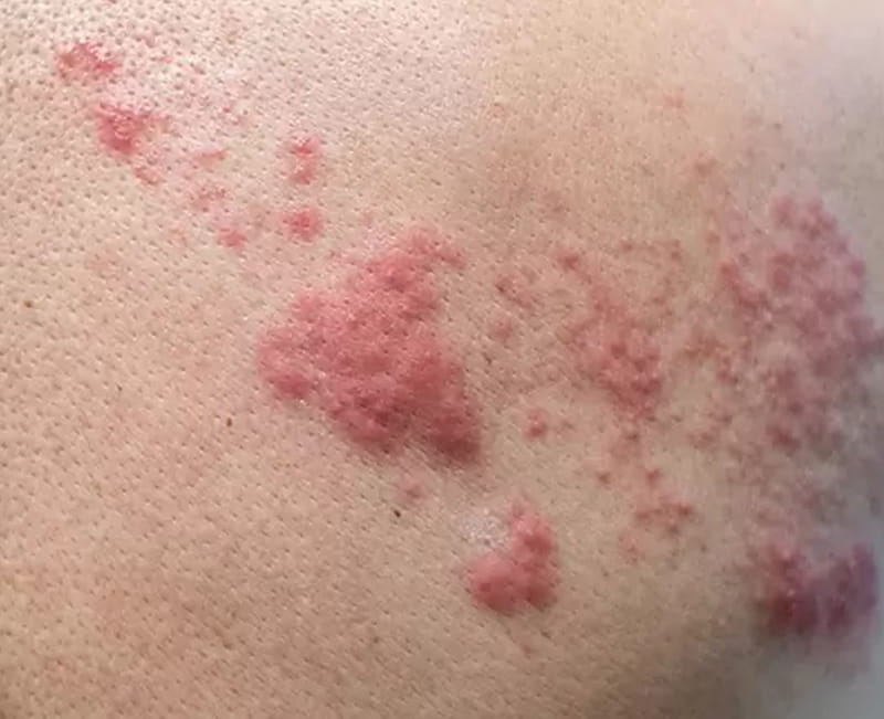 Herpes Zoster