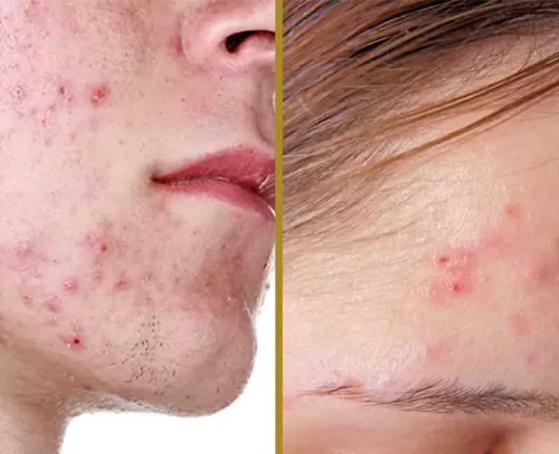 Acne
