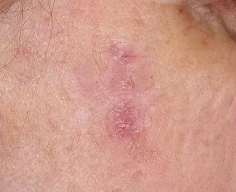 Actinic Hyperkeratosis