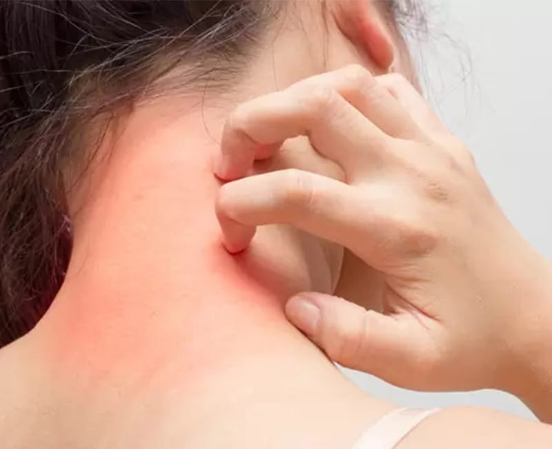 Atopic Dermatitis
