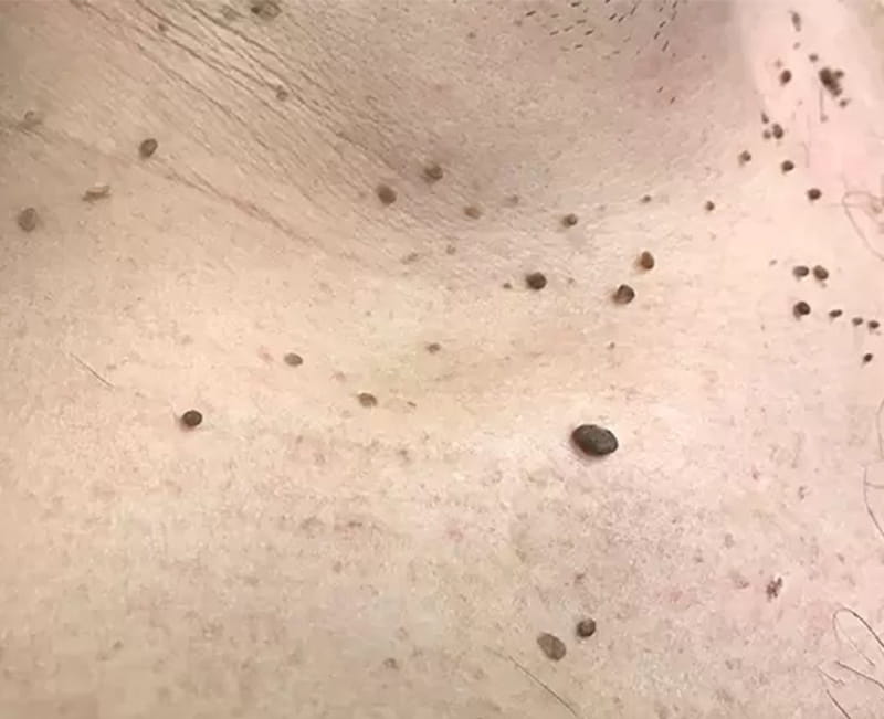 Papilloma Removal