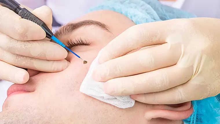 Mole Removal