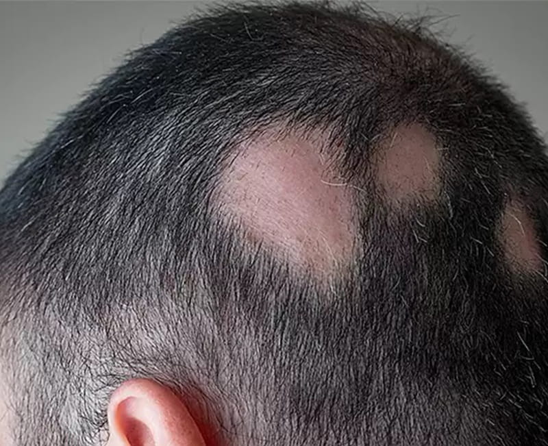 Alopecia areata