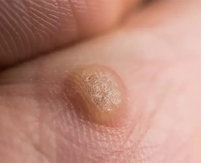 Wart treatment