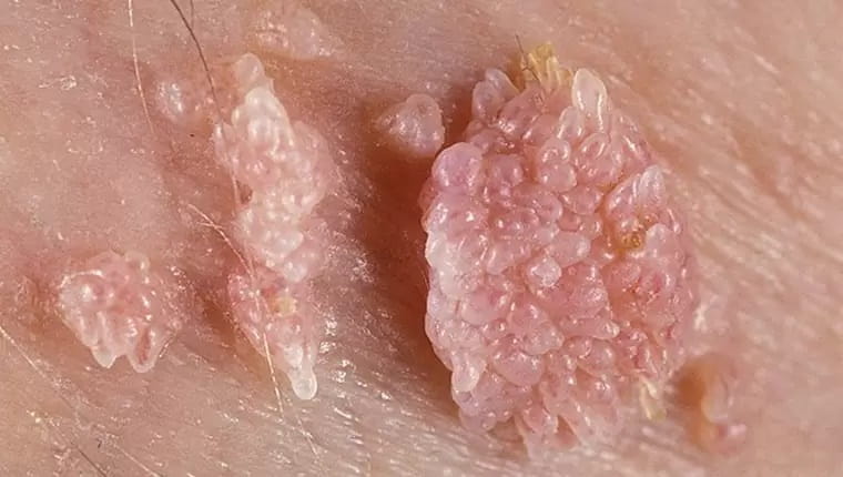 Genital warts