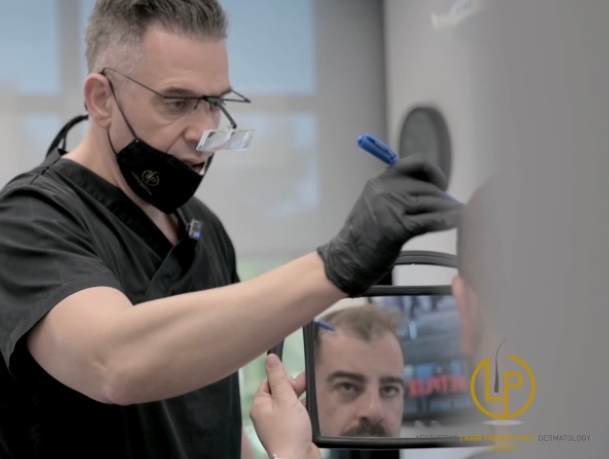 Μεταμόσχευση Μαλλιών δεύτερο στάδιο - LP Clinic