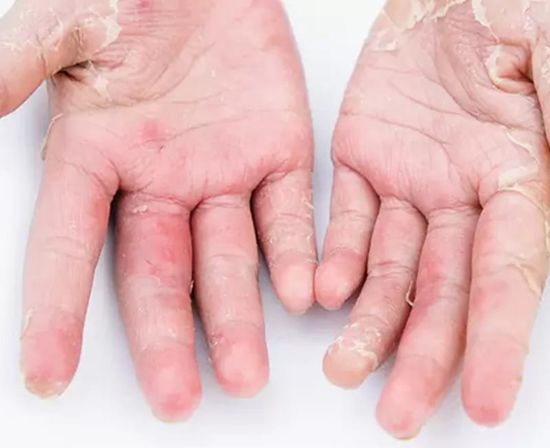 Mycosis