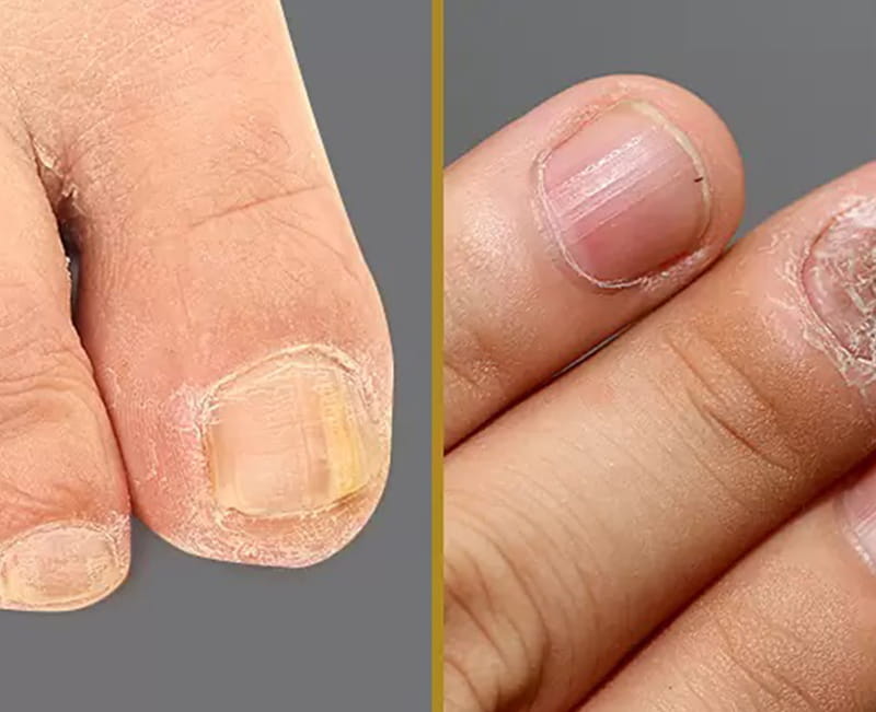 Onychomycosis