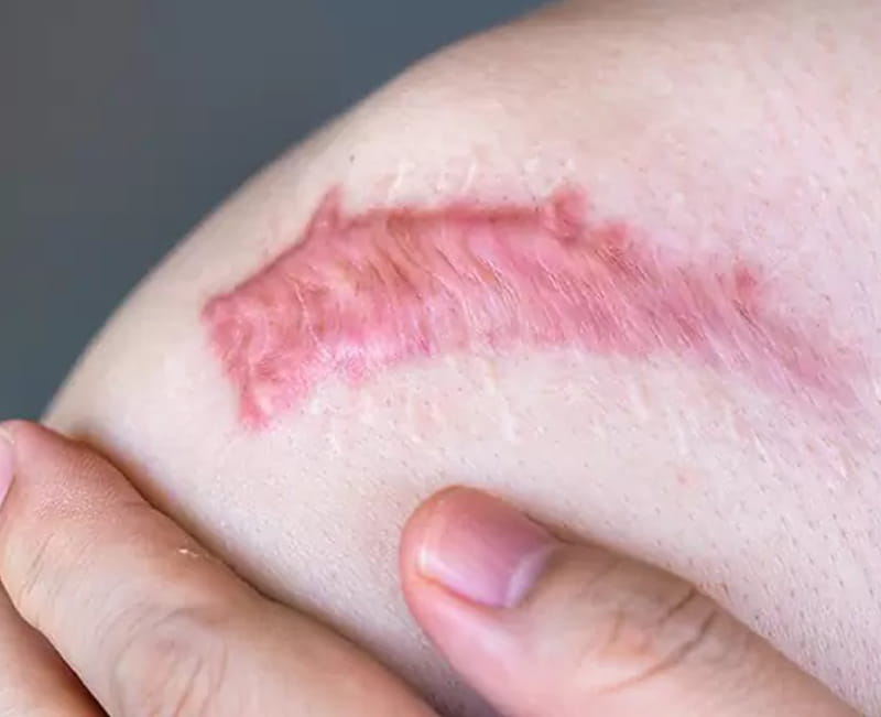 Scars and Keloids
