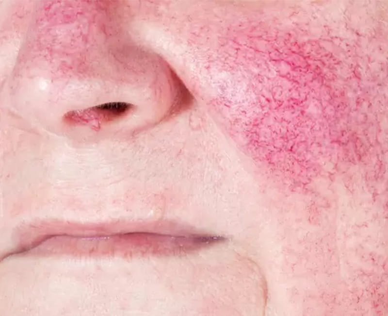 Rosacea