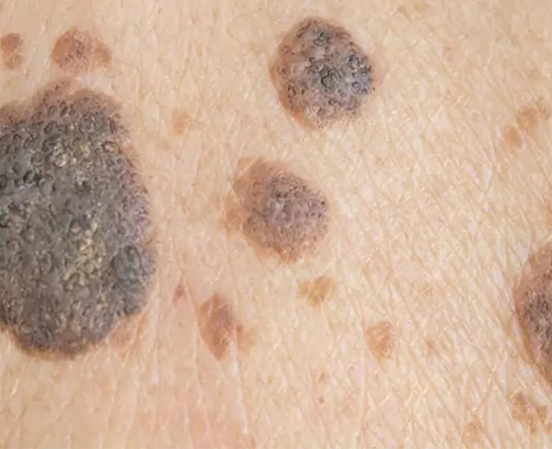 Seborrheic Hyperkeratosis