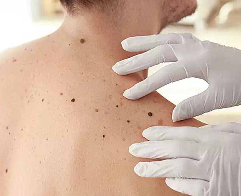 Mole Mapping