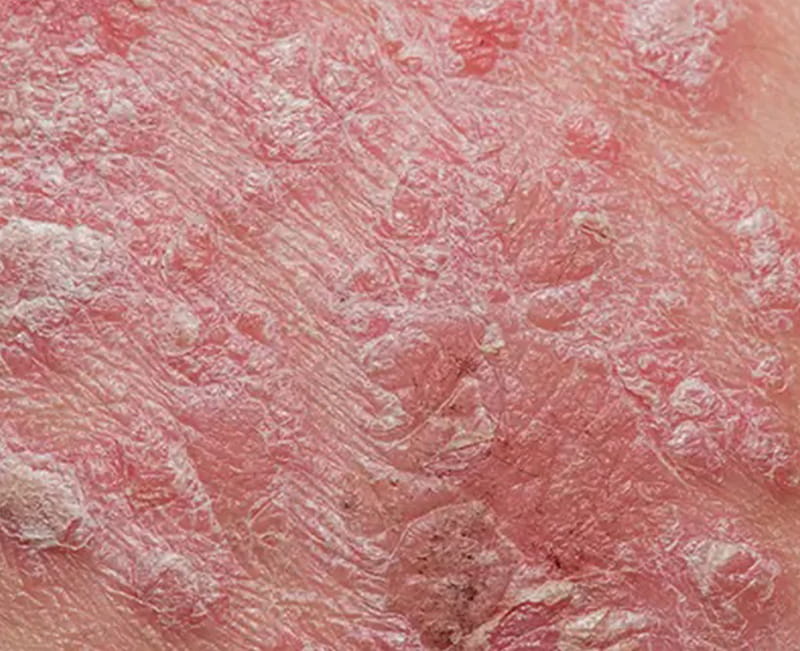 Psoriasis
